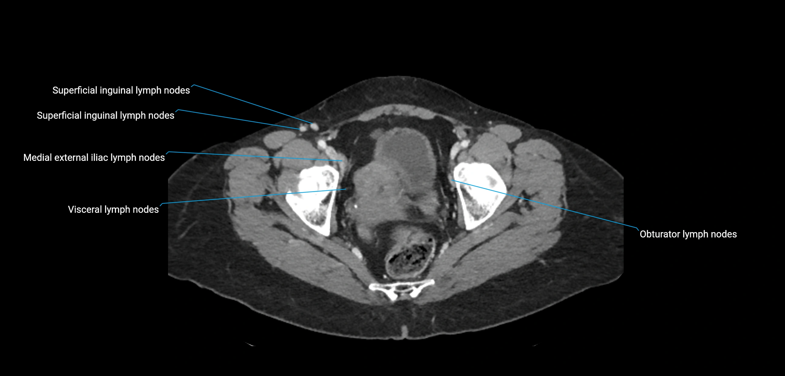 CT ct abdominal lymph nodes  axial cross sectional anatomy  enchanced radiology image -img-00002-00378.webp